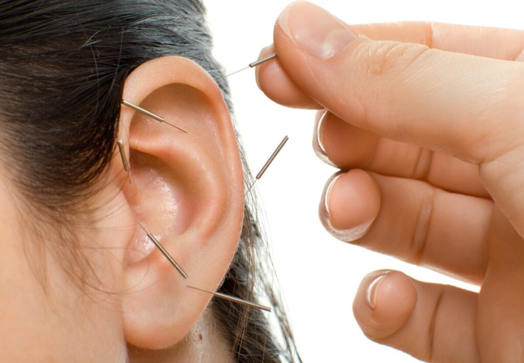 Auricular Therapy | Shraddha Physiotherapy Clinic - Best Physiotherapy in Ahmedabad